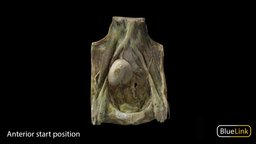 Ectopic Kidney anatomy, kidney, ectopic