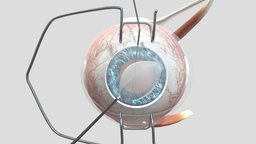 DMEK eye, membrane, surgery, keratoplasty, dmek, descement, endothelial