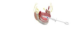 Inferior Alveolar Nerve Block mouth, anatomy, injection, teeth, tooth, education, medicine, elearning, dentistry, sciart, university-of-dundee, school-of-dentistry, anaesthetic, uod, sdeo, scottish-dental-education-online, anesthetics, maya, zbrush